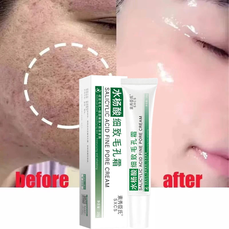 Salicylic Acid Pore Shrinking Cream – Blackhead Removal & Smooth Skin